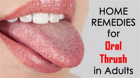 Home Remedies for Oral Thrush in Adults - Get Complete Information