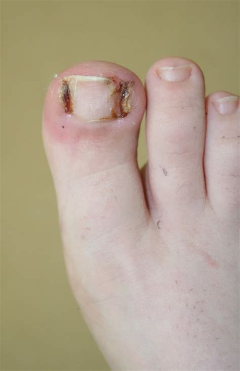 Ingrown Toenail Surgery - Buderim Podiatry | Sunshine Coast podiatrist ...