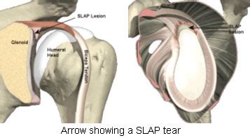 SLAP Tears | JointSurgery.in