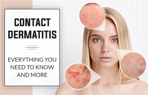 Contact Dermatitis: Everything You Need to Know and More | Winston ...