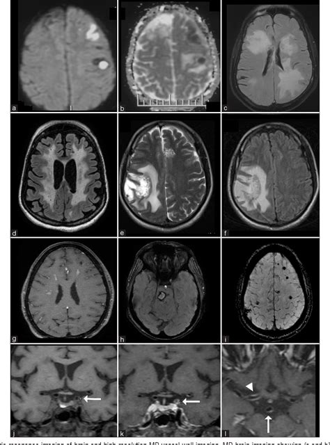 Primary Angiitis of the Central Nervous System – Diagnosis and ...