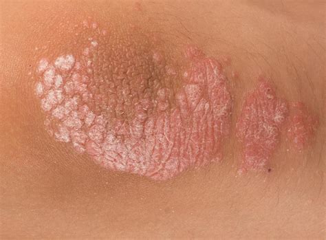 Medical News Today: What Does a Psoriasis Rash Look Like? - Medical ...