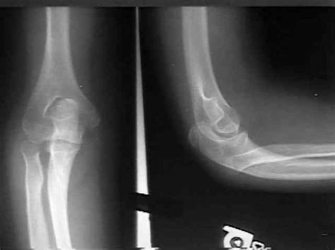 Congenital Dislocation of Radial Head : Wheeless' Textbook of Orthopaedics