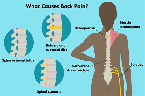 Lower Back Pain Causes - Chronic Lower Back Pain - Chronic Lower Back ...