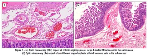 Management of Intestinal Angiodysplasia and Cataclysmic Hemorrhage