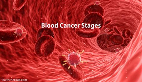 Blood Cancer Stages and Survival Rates - Health Checkup