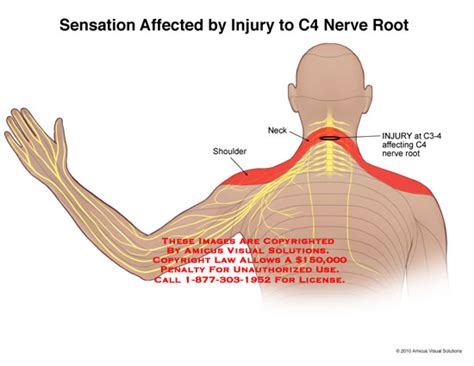 AMICUS Illustration of amicus,medical,injury,c4,nerve,root,sensation ...