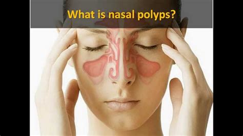 Nasal Polyp Causes Symptoms Treatment Nasal Polyp