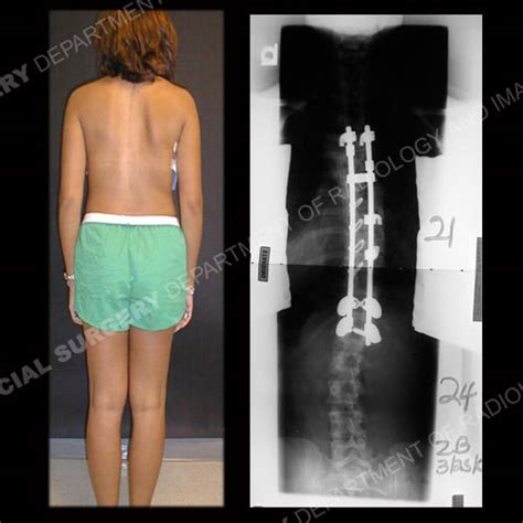 Scoliosis in Adults: What to Know About Symptoms & Treatment