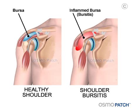 Shoulder Bursitis - Back in Action