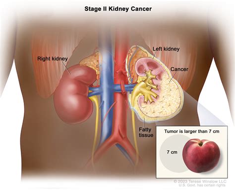 Renal Cell Cancer Treatment - NCI