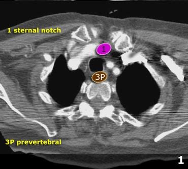 The Radiology Assistant : Mediastinum - Lymph Node Map