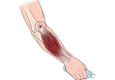 Lateral Epicondylitis Test