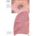 Centriacinar (Centrilobular) Emphysema