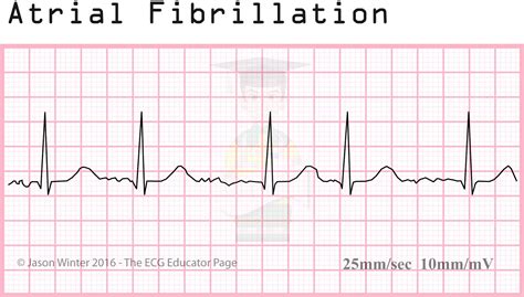 Atrial Fibrillation Ecg Interpretation | Hot Sex Picture