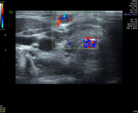 Thyroid Follicular Carcinoma Ultrasound