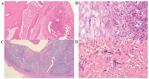 Figure 7 from Lateral retropharyngeal lymph node metastasis from ...