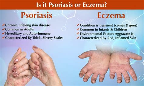 Natural Help for Eczema and Psoriasis