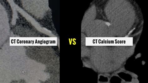 CT Coronary Angiogram vs CT Calcium Score | Differences