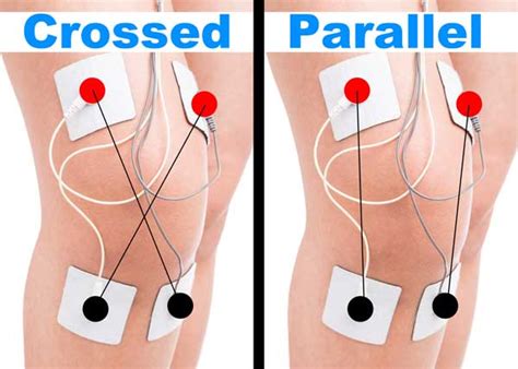 BEST Tens Placement for Knee Pain