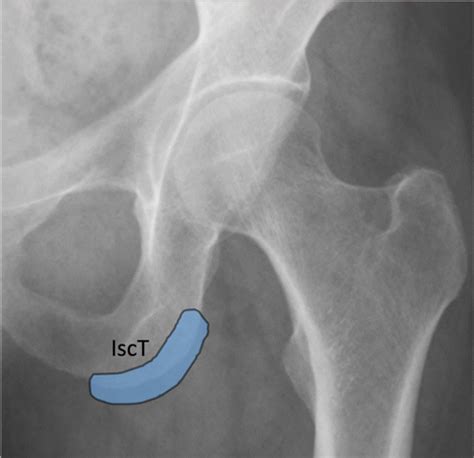 Hip Bursitis Injection