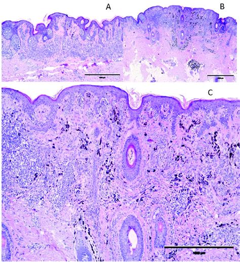 Combined nevus histopathological findings: A. epidermal and dermal ...