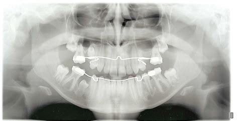 Timing and Assessment of Ankylosed Deciduous Molar Teeth - A Case ...