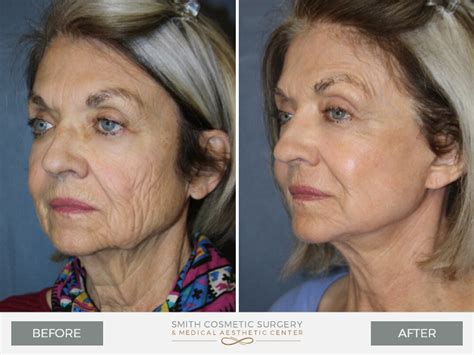 Laser Resurfacing Denver Before & After Photos | Facial Plastic Surgery ...