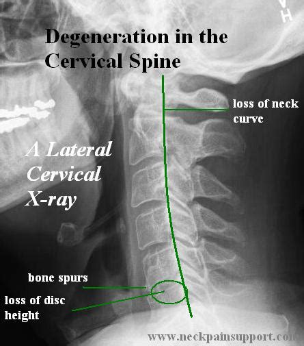 Cervical Disc Degeneration. Causes, symptoms, treatment Cervical Disc ...