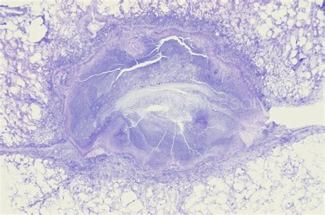 Acute Abscess on Lung, LM | Stock Image - Science Source Images