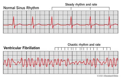 Ventricular Fibrillation Heart