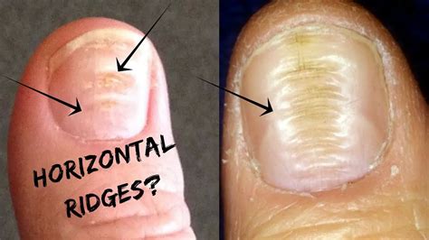 Vertical Lines On Nails - Fingernail Ridges Can Indicate a Thyroid ...