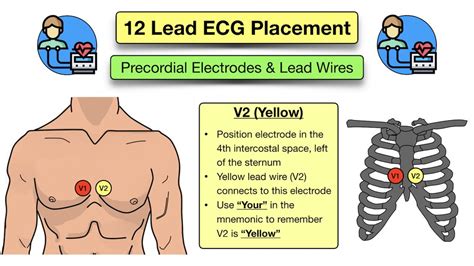 12 Lead ECG Placement: Diagram and Mnemonic for Limb and Precordial ...