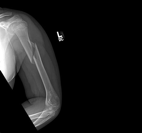 OrthoDx: Pediatric Humerus Fracture - Clinical Advisor