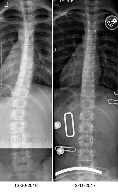 Thoracolumbar Scoliosis | Scoliosis of the Mid-Spine