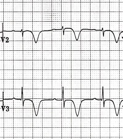 Wellens Syndrome • LITFL • ECG Library Eponym