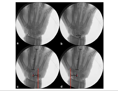 Dislocated wrist | Semantic Scholar