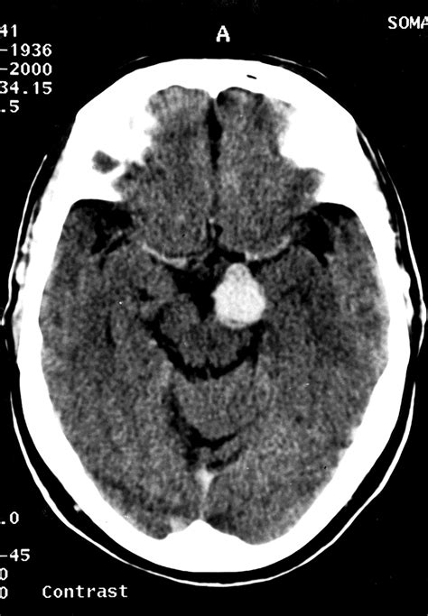 Brain Aneurysm Ct Scan - Diagnosis of a brain aneurysm may require ct ...