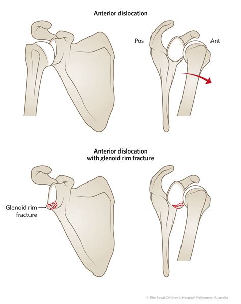 dislocated shoulder urgent care or er - lacresha-spaid