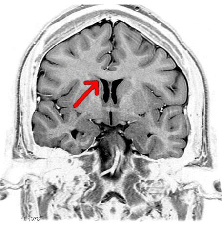 Corpus Callosum | Function, Etymology, Location & Anatomical Structure