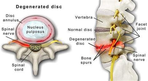 Understanding Degenerative Disc Disease: Causes, Symptoms, and ...