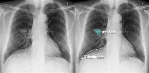 Chest X-ray - Lung cancer - Phrenic nerve palsy