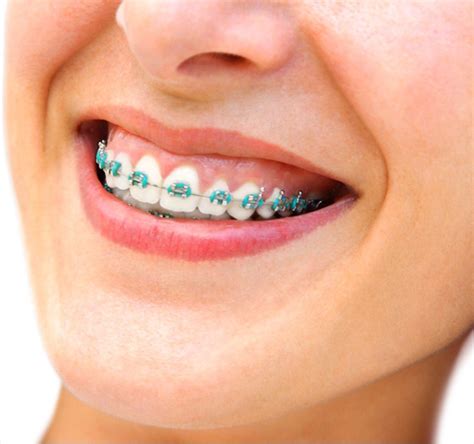 √ Braces Color Teal