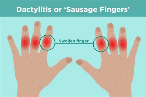 Als Symptoms In Hands : Finger Twitching 9 Causes And When To See A ...