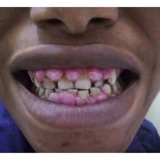 Photograph showing amlodipine-induced gingival hyperplasia. | Download ...