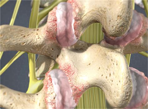 Lumbar Facet joint Rhizotomy for Low Back pain - Welcome Back Clinic ...