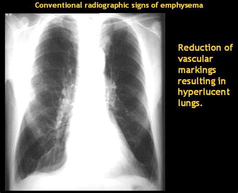 Emphysema (Chronic Obsructive Disease) – Meddiction