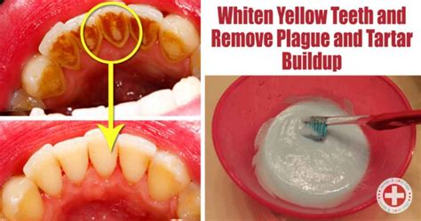 The Best Ways for Natural Teeth Plaque and Tartar Removal – 99easyrecipes