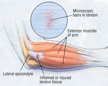 Tennis Elbow (Lateral Epicondylitis) Guide: Causes, Symptoms and ...