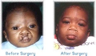 Fun Facts About Cleft Lip Palate - Infoupdate.org